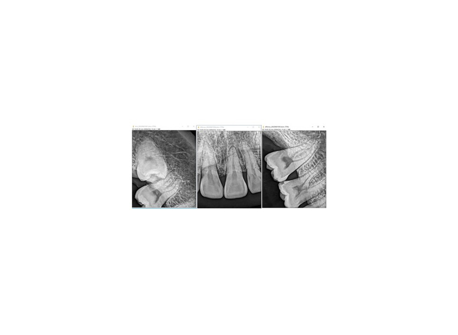 سنسور رادیوگرافی داخل دهانی U Sensor سایز 1.5 برند WOODPECKER