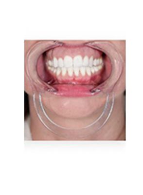 |دهان بازکن خارج دهانی برند OrthoTechnology